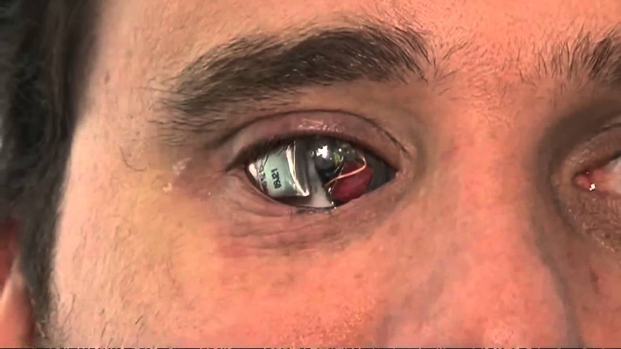 24. Бионический глаз.